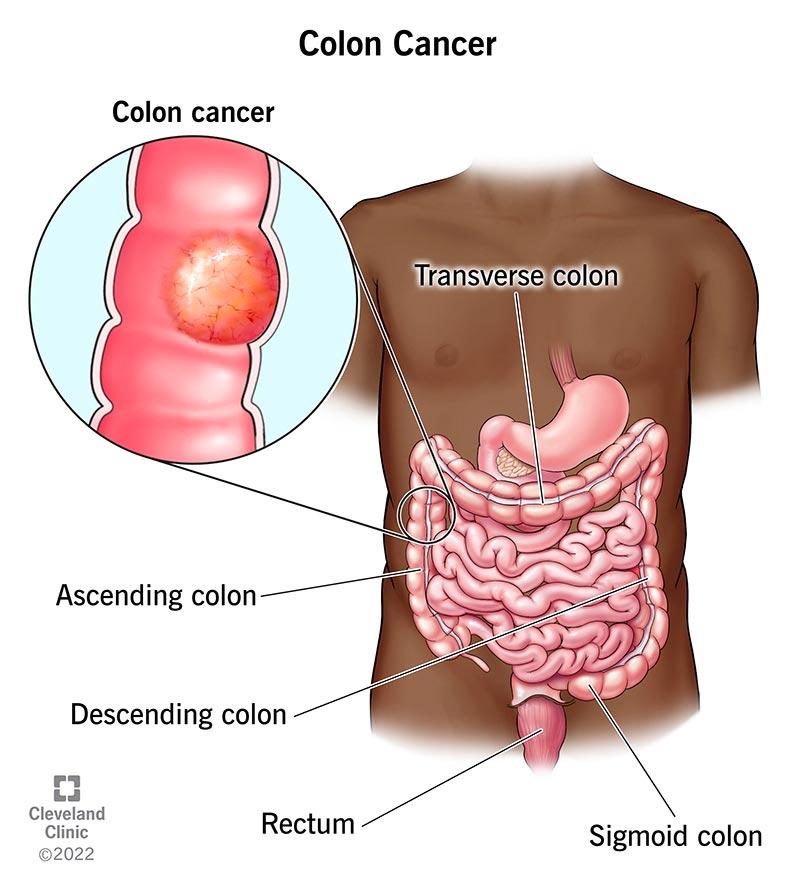 Colon Cancer Awareness: Screening, Prevention, and Early