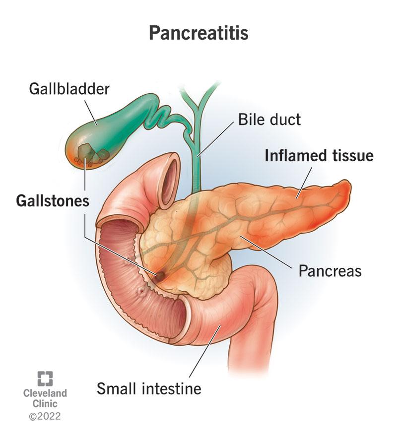 Unraveling Pancreatitis