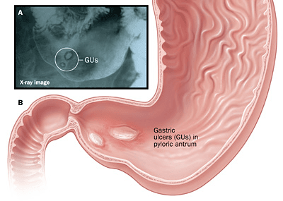 Understanding Duodenal Ulcers: Causes, Symptoms, and Treatment