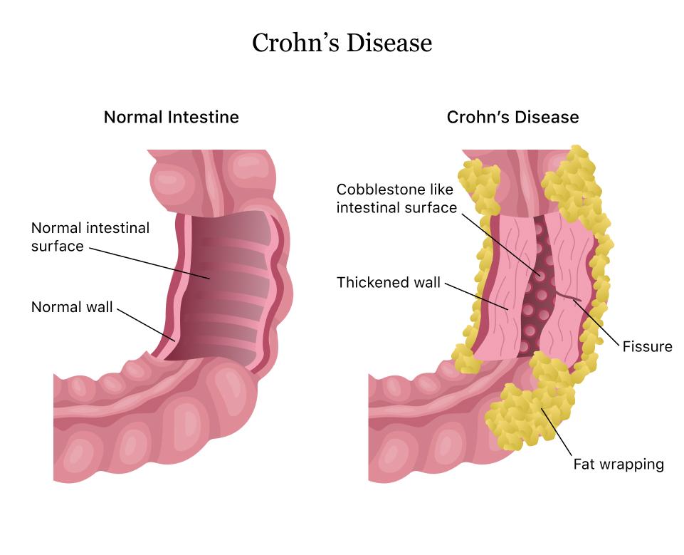 Understanding Crohn's Disease